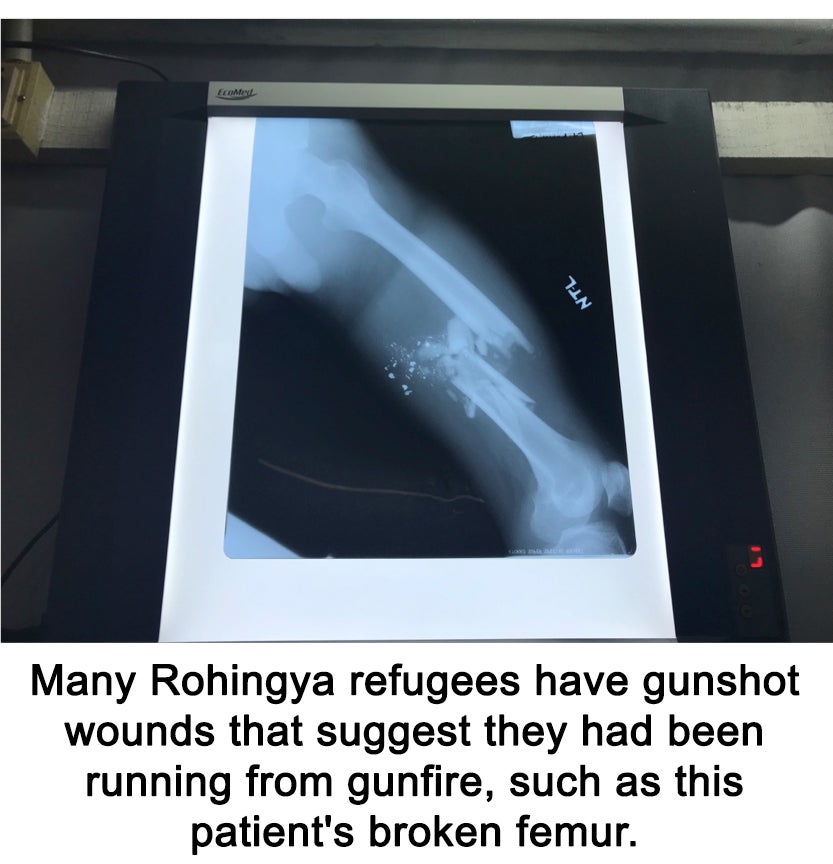 An X-ray film displaying a complete fracture to the femur (thigh bone)