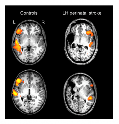 Individual scans of two healthy controls and two individuals with a left-hemisphere (LH) perinatal stroke.