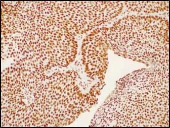 Microscopic image of bladder cancer cells