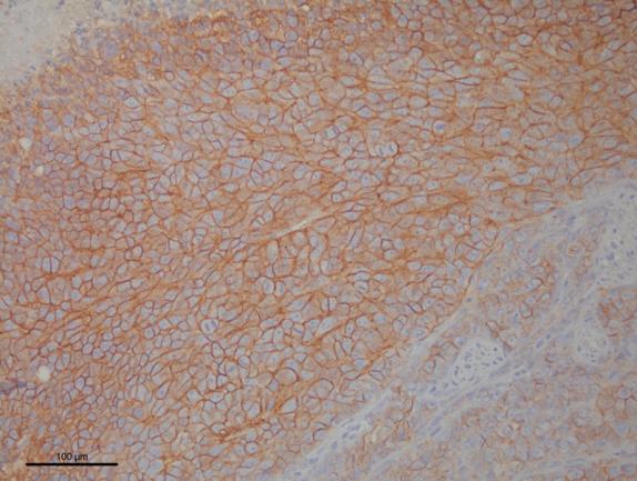 This image shows irregular shaped cells characteristic of Ewing sarcoma