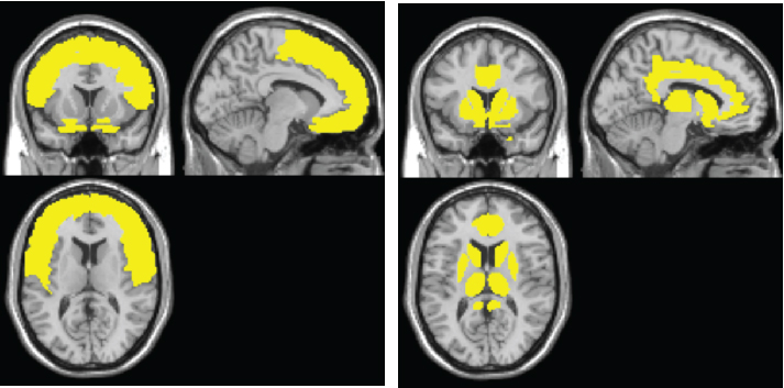 Brain scan images with areas highlighted in yellow