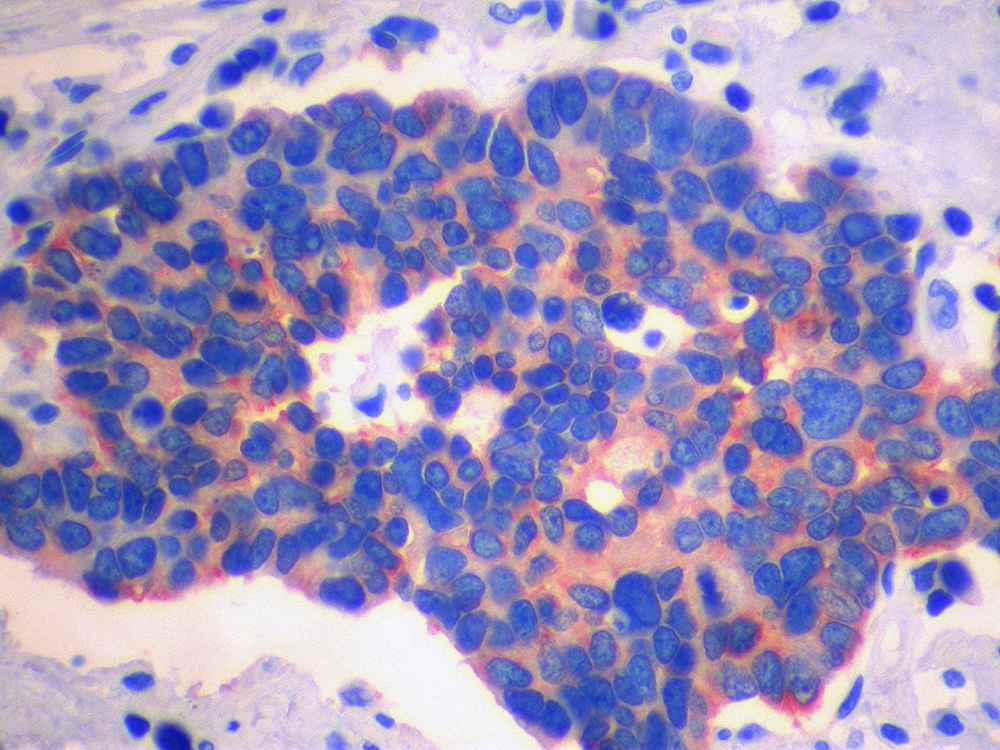Small cell lung cancer cells appear in blue and pink