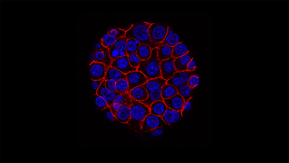 A microscopic view of a pancreatic cancer cell