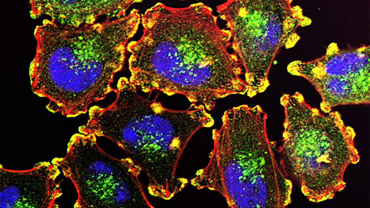 Microscopic view of melanoma cells with cell structures stained bright colors