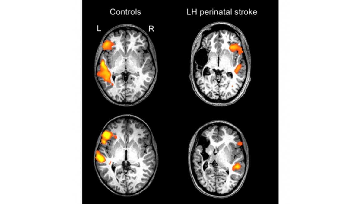 Four brain scans with orange highlights showing areas of activity