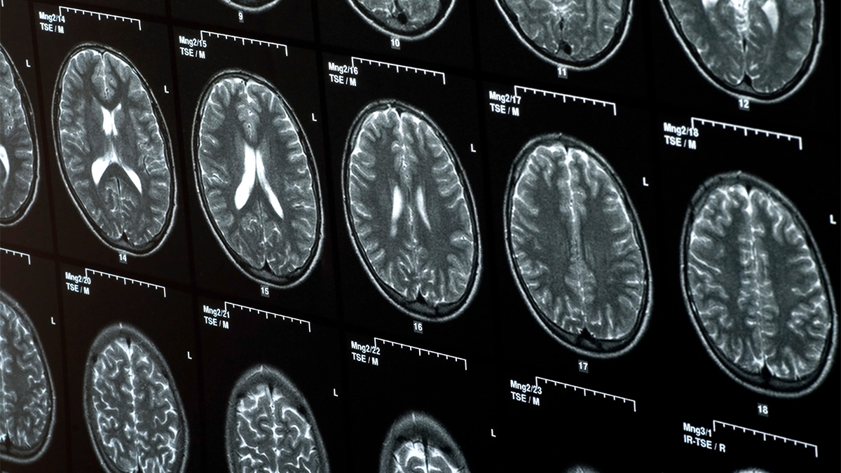A brain MRI series