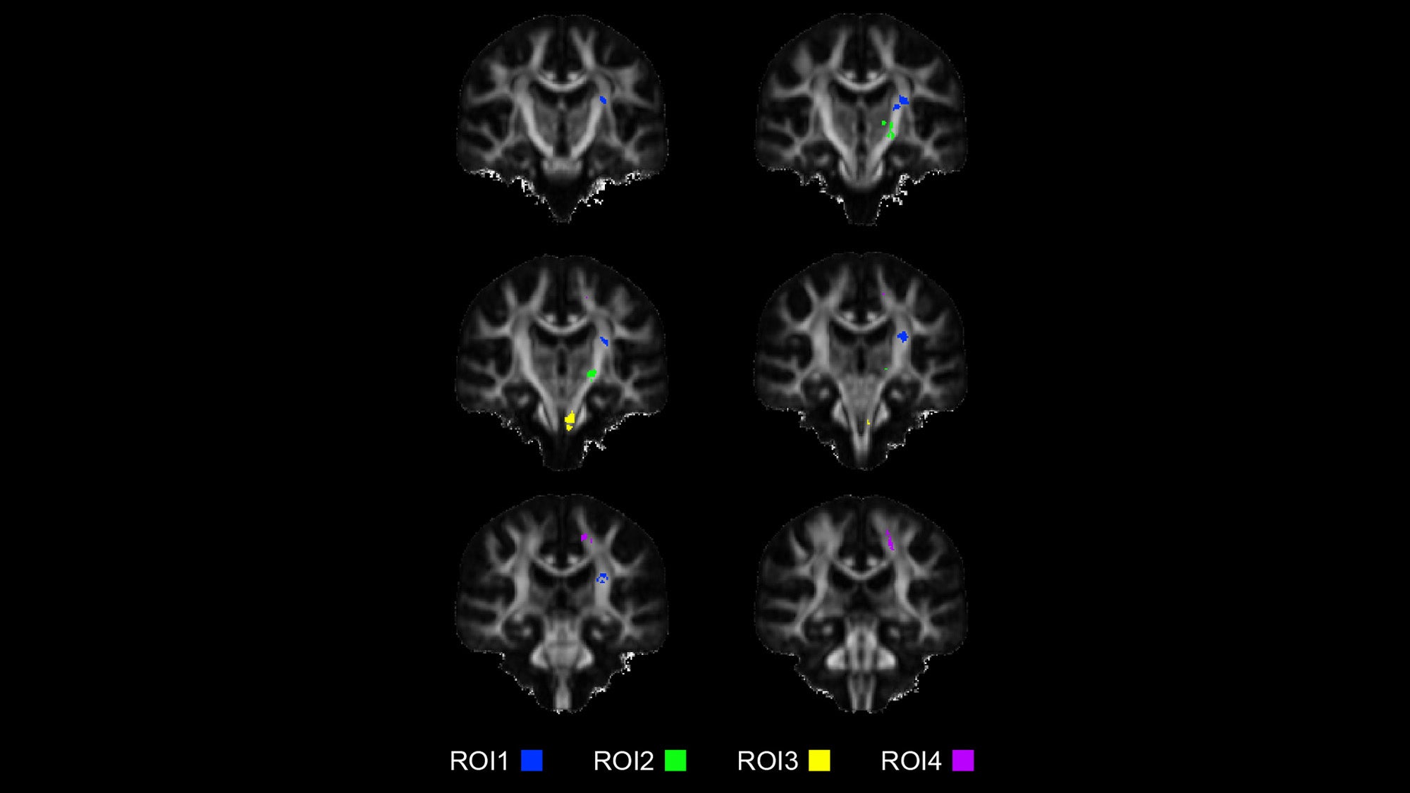 Six brain MRIs appear two by two, each with a tiny bit of color in different areas