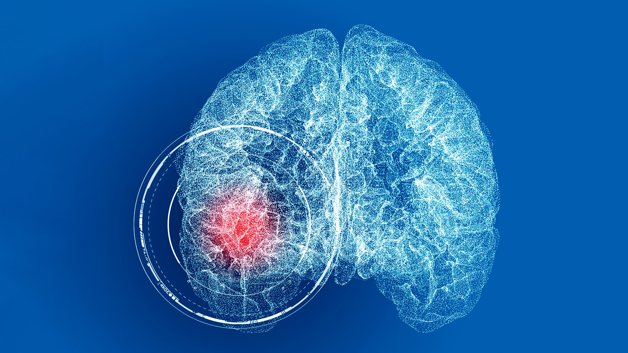 White illustration of a brain with a red circle indicating stroke on a blue background