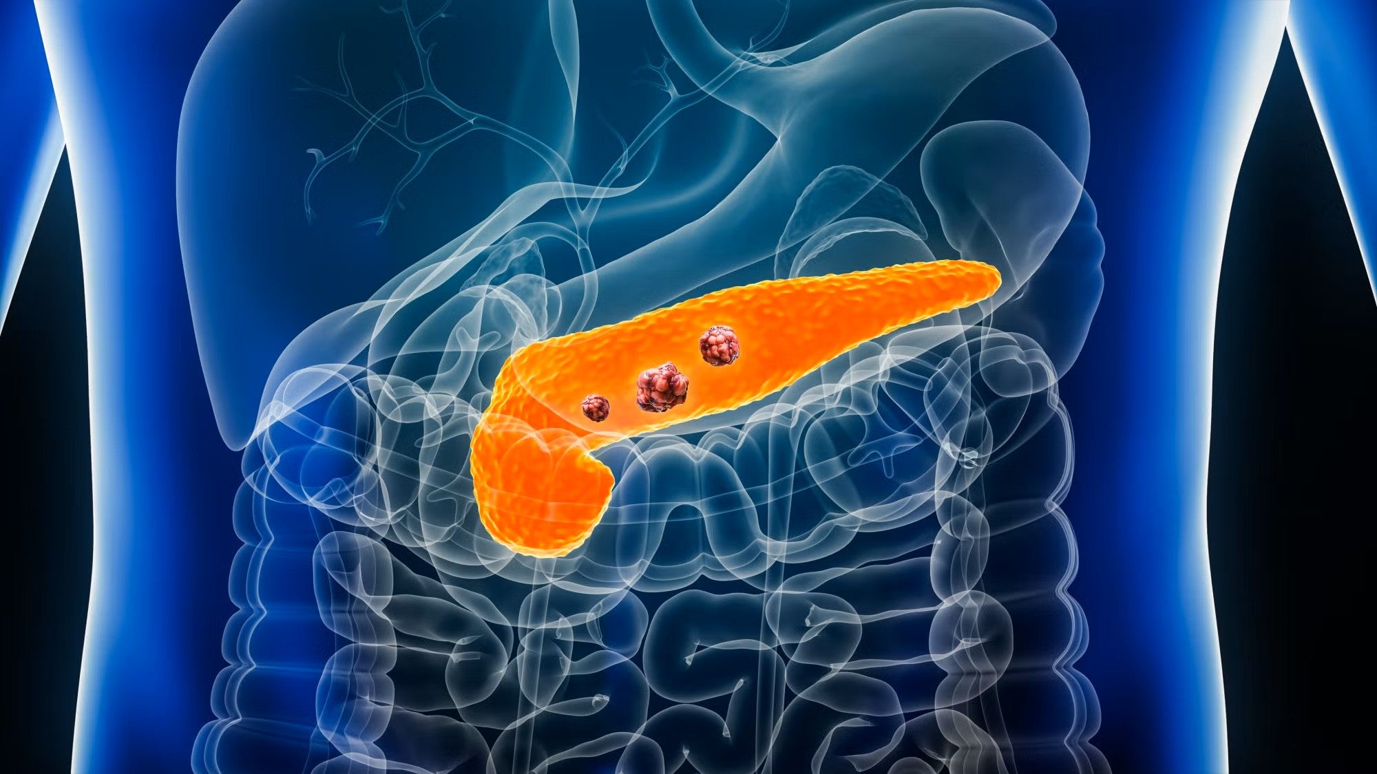 An illustration depicts pancreatic cancer in the body