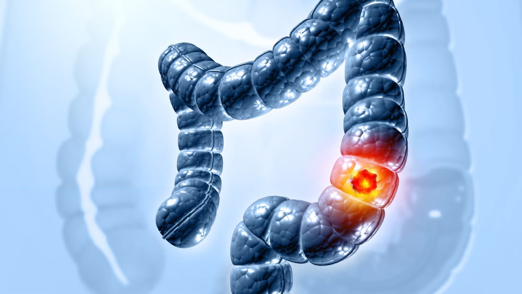 Illustration of a large intestine with a segment highlighted indicating cancer